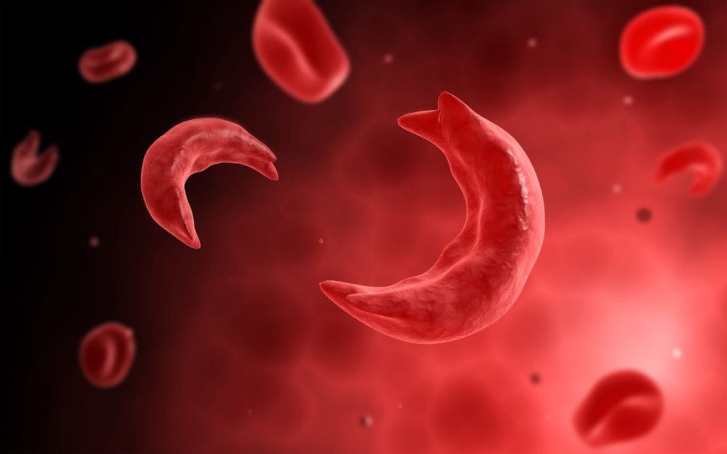 Microscopic view of sickle-shaped red blood cells among normal round red blood cells